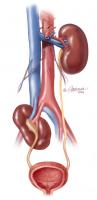 Ectopic kidney